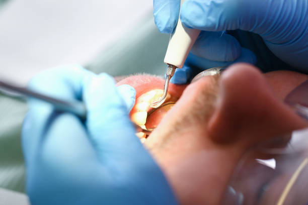 Best Emergency Root Canal Treatment in Charlotte Park, FL