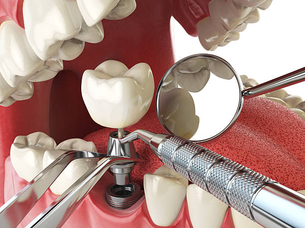 Best Emergency Wisdom Teeth Removal in Charlotte Park, FL